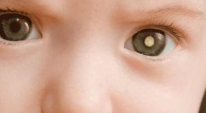 Entenda O Que Retinoblastoma E Como Diagnosticar Esse Tipo De C Ncer